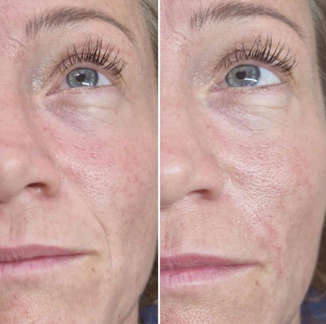 Silent filler (Nasolabial fold) and classic lash extensions