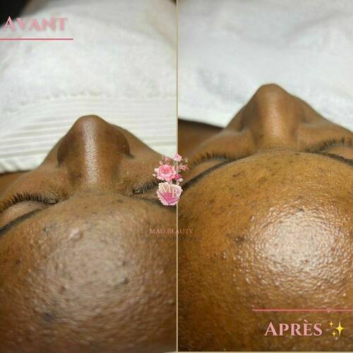 Avant/après une séance de soin du visage anti-imperfection