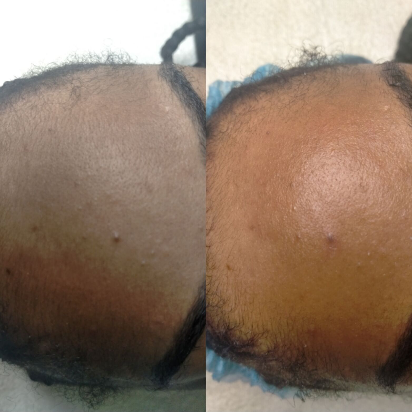 Dermaplaning 