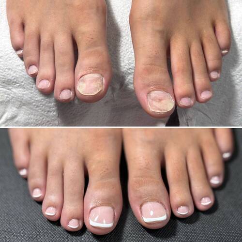 Avant VS Après : Reconstruction ongulaire