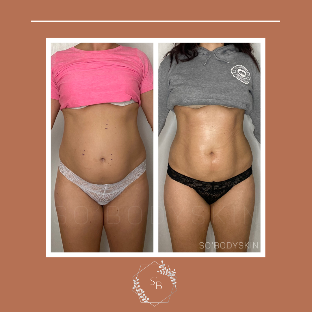 Pack Minceur (Lipocavitation + Radiofréquence) - Résultat après la cure de 6 séances