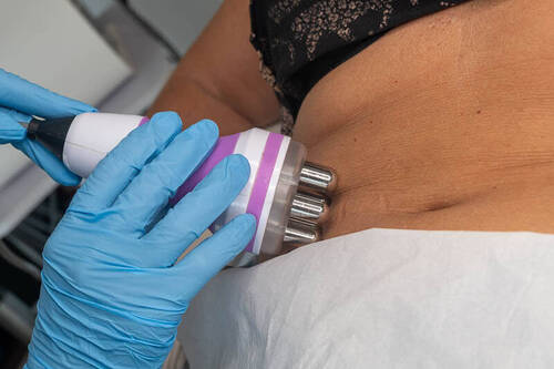 Body sculpting cavitation radio frequency 