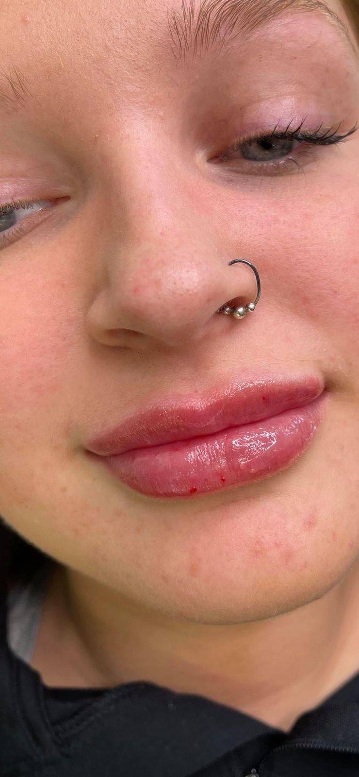 1.1ml Lip Enhancement 