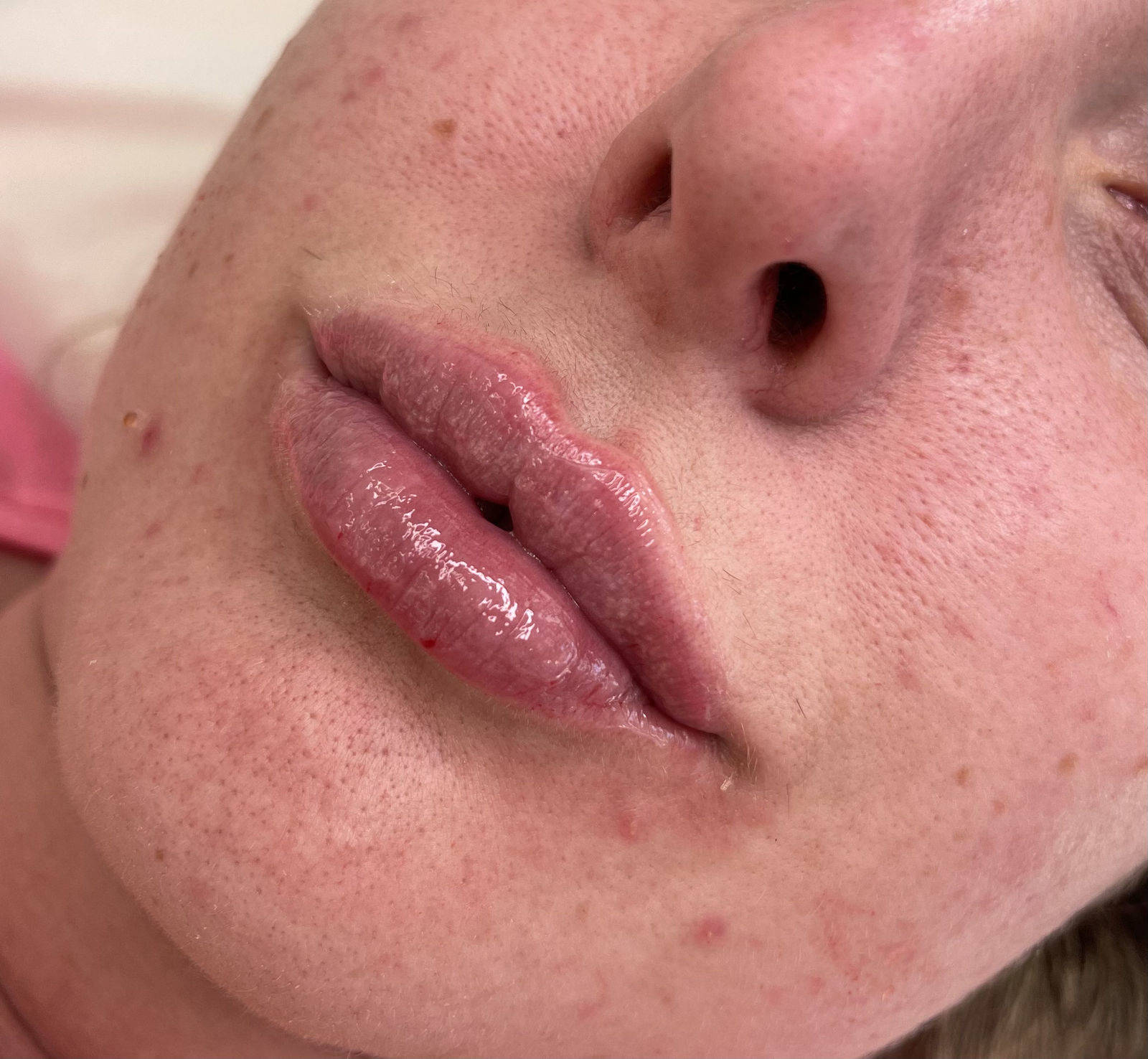 1.1ml Lip Enhancement 