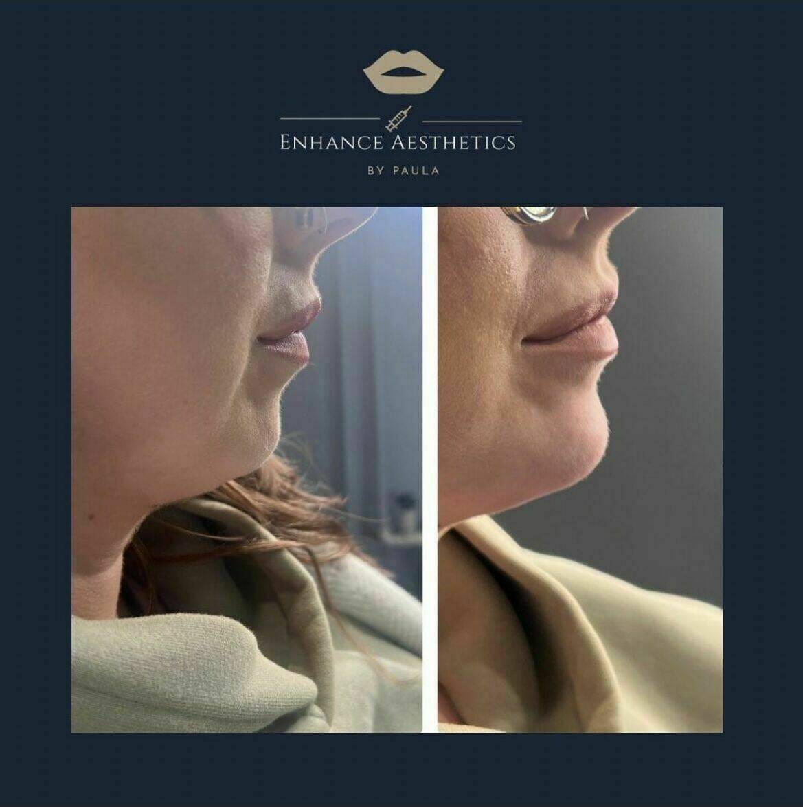 Profile balancing using dermal filler in the chin