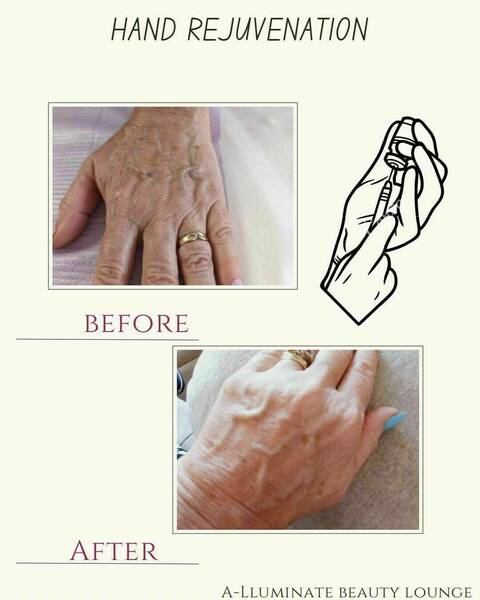 Hand rejuvenation