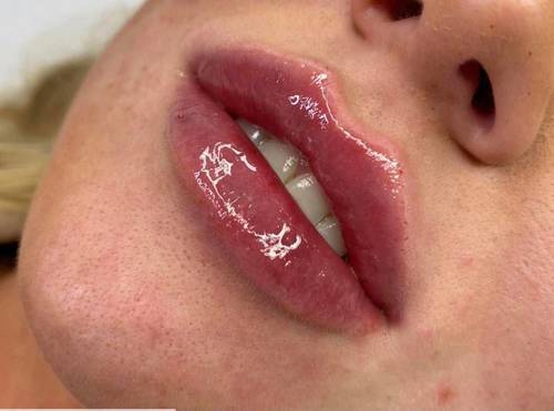 1.1ml Lip Enhancement 