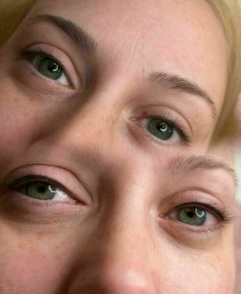 Wimpernkranzverdichtung 