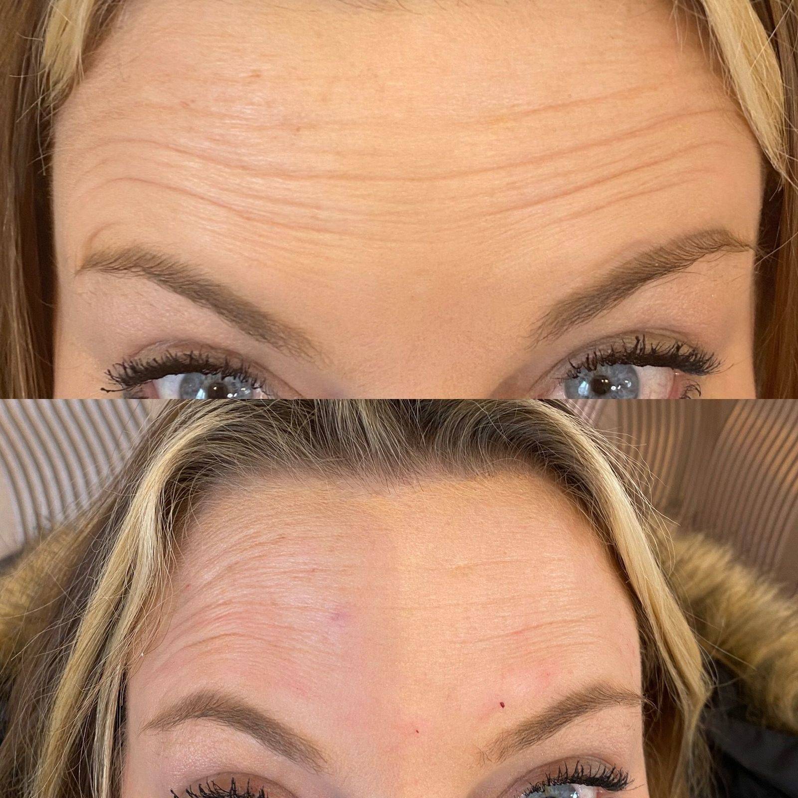 Botox Before and Afters