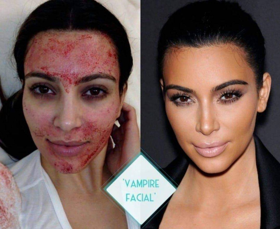 Vampire Facial (Block of 6)