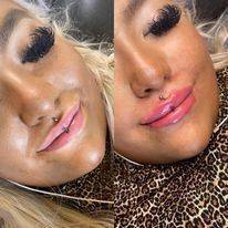 Lip Fillers Before and After