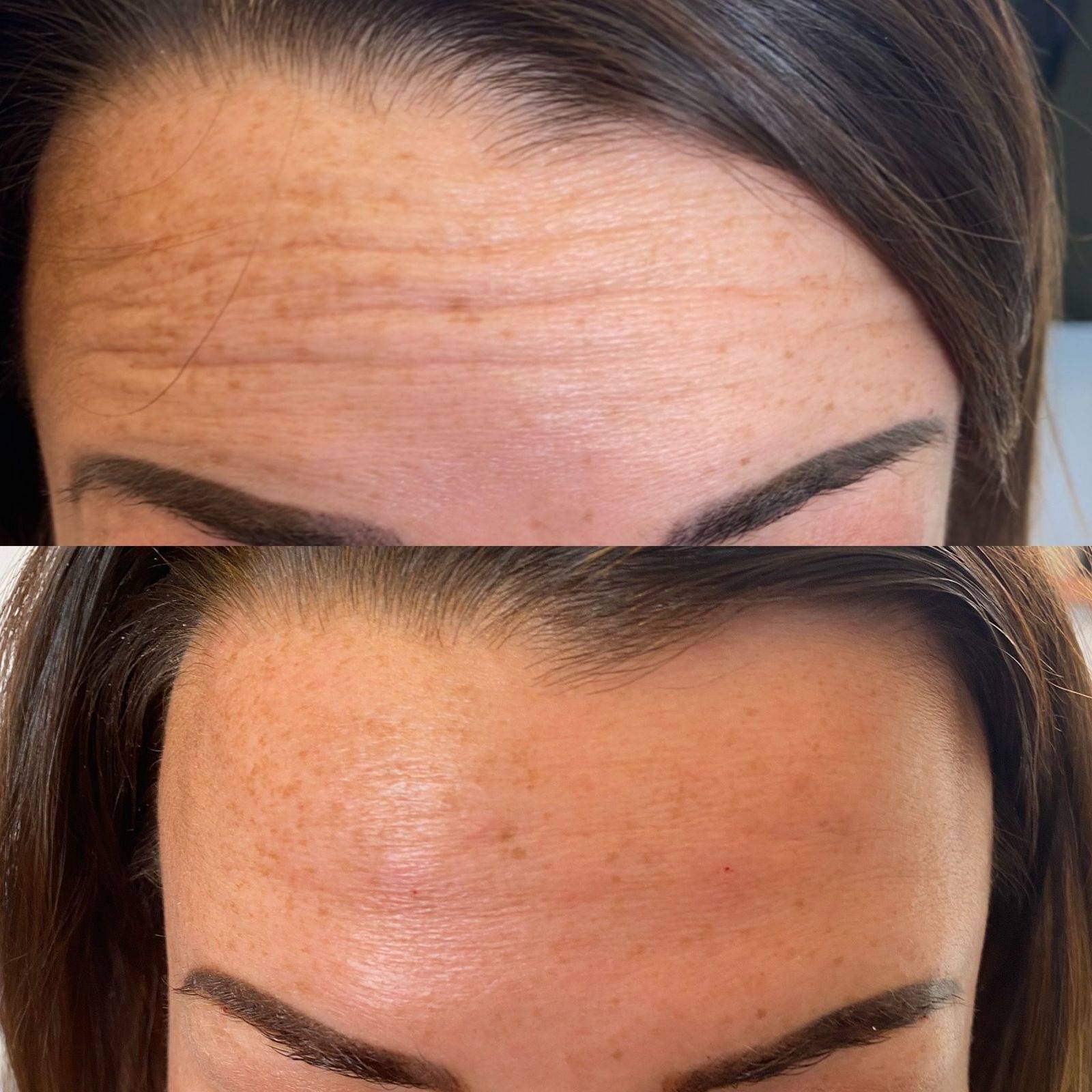 Botox Before and Afters