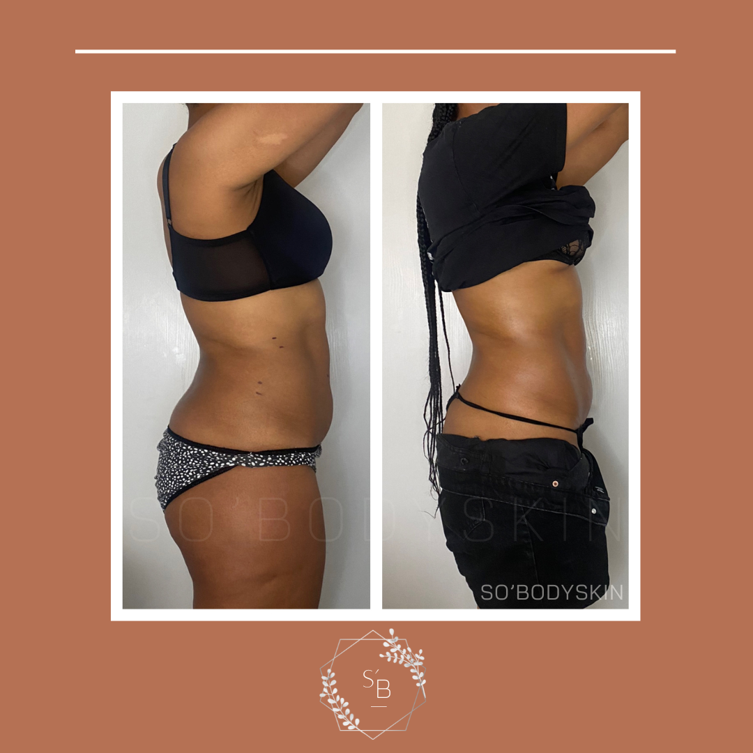 Pack Minceur (Lipocavitation + Radiofréquence) - Résultat en 3 séances