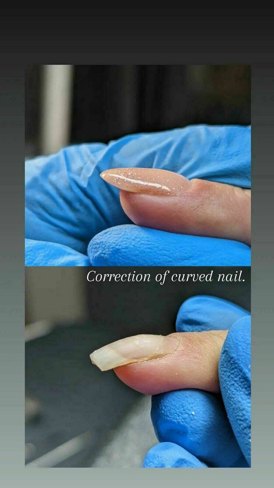 Nail correction with acrygel 