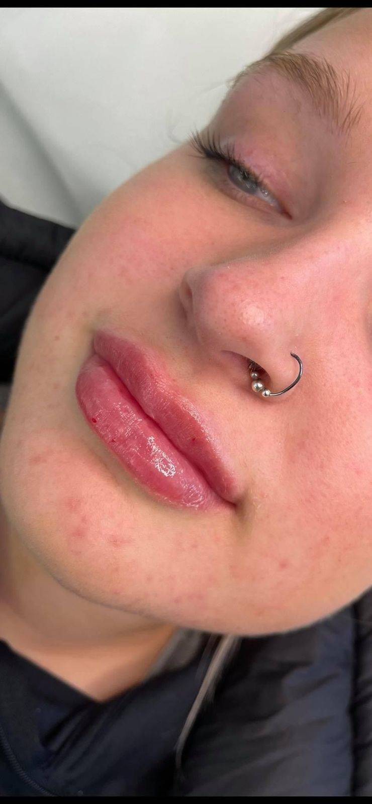 1.1ml Lip Enhancement 