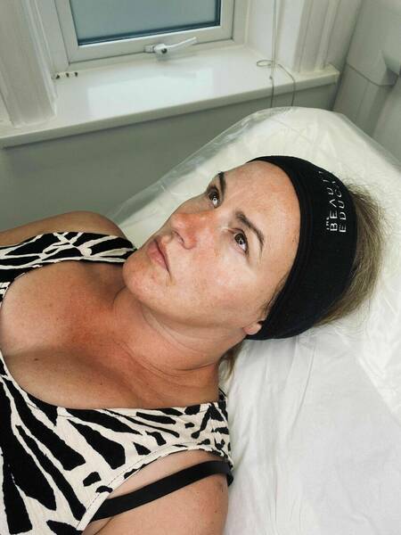 Dermaplaning Deluxe, ensuring to remove dead skin cells and facial hair. Combined with various medically graded products to re-hydrate the skin. 