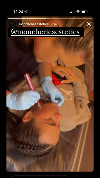 Microneedling Facial