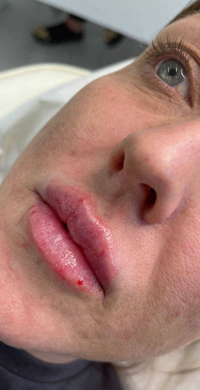 1.1ml Lip Enhancement 