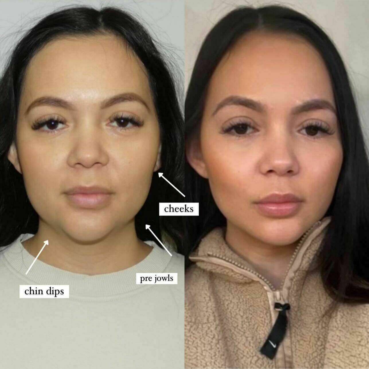 Facial balancing experts. Softening and elevating your features transforming your confidence. 