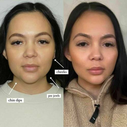 Facial balancing experts. Softening and elevating your features transforming your confidence. 