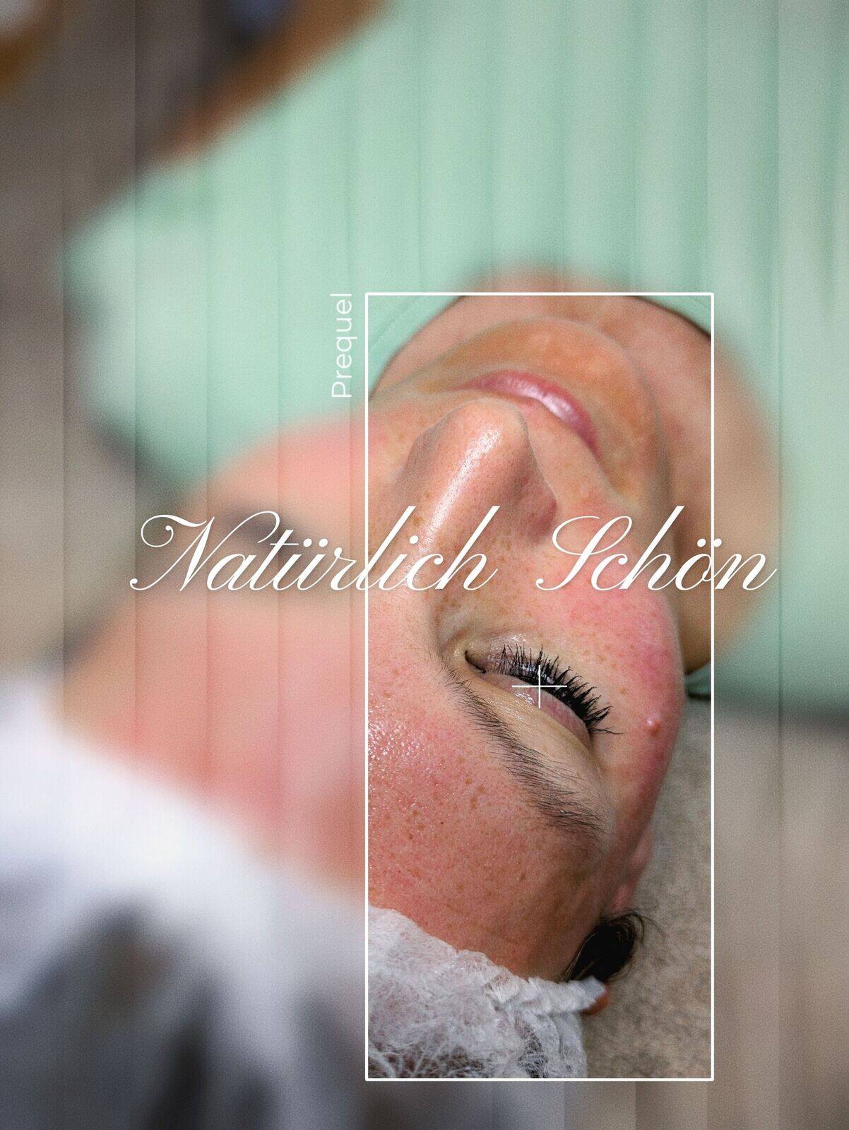 Microneedling ✨️