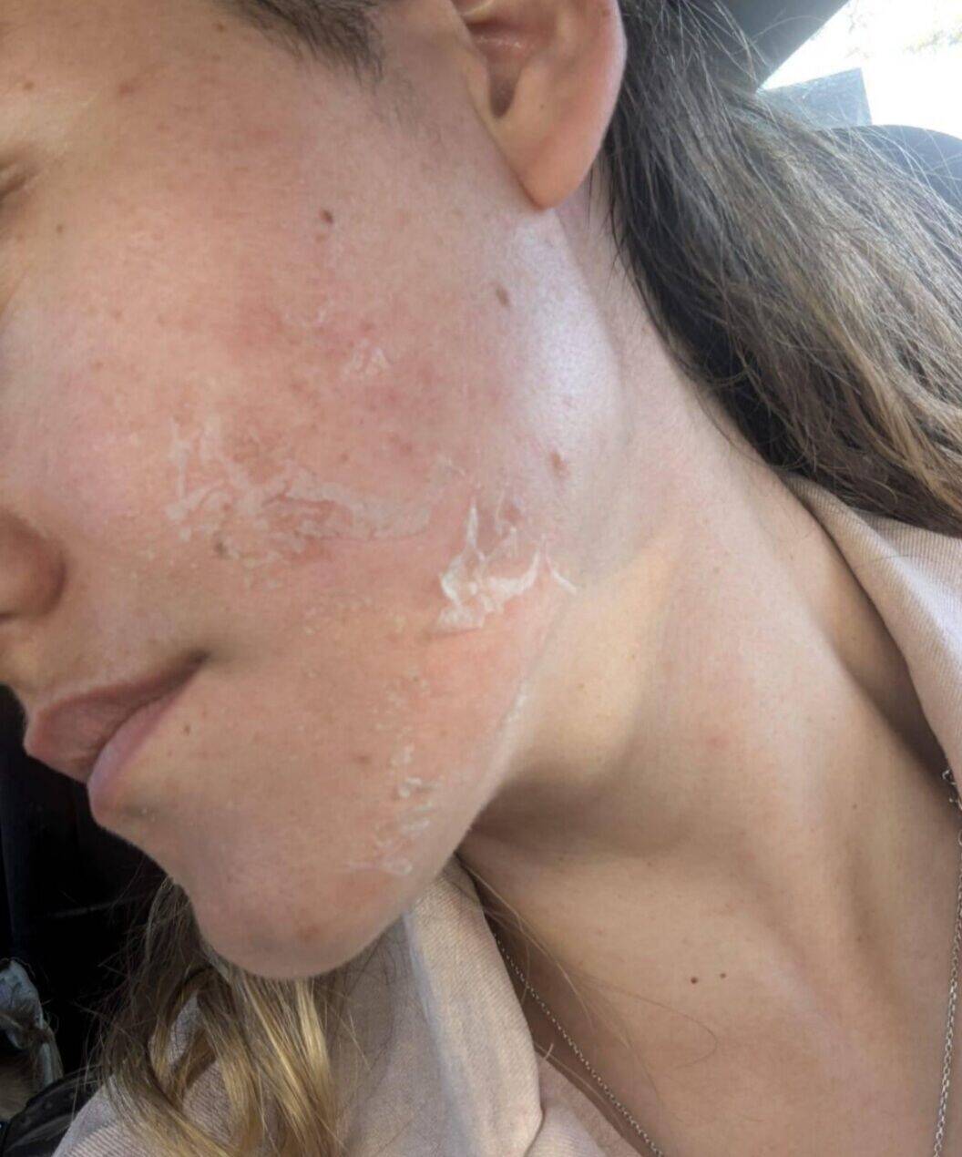 Bio-Mikroneedling ( Schällung)