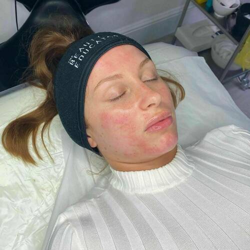 The Ultimate Glow Up, including extraction, chemical peel, dermaplaning, dermaroller and various medically graded products to achieve the ‘Ultimate Glow’ 