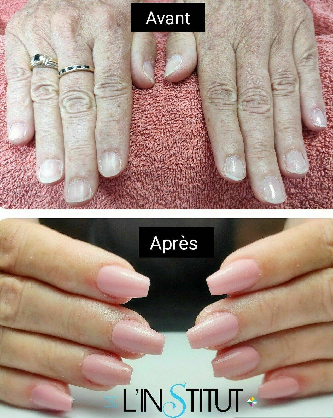 Avant / Après pose capsules Américaine