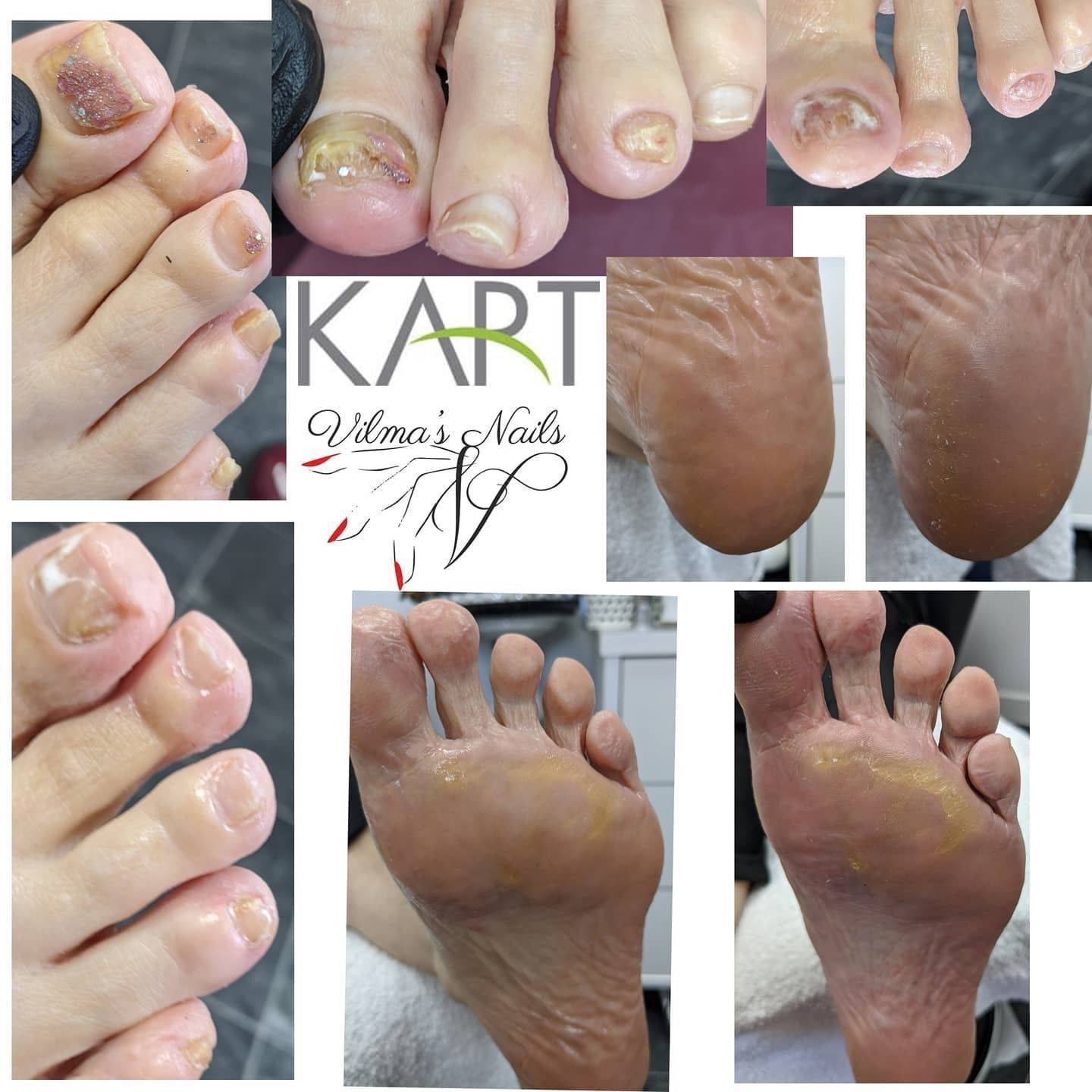 Done 1st KART PEDICURE TREATMENT.Start using Clearance Protective for Fungal nails.
