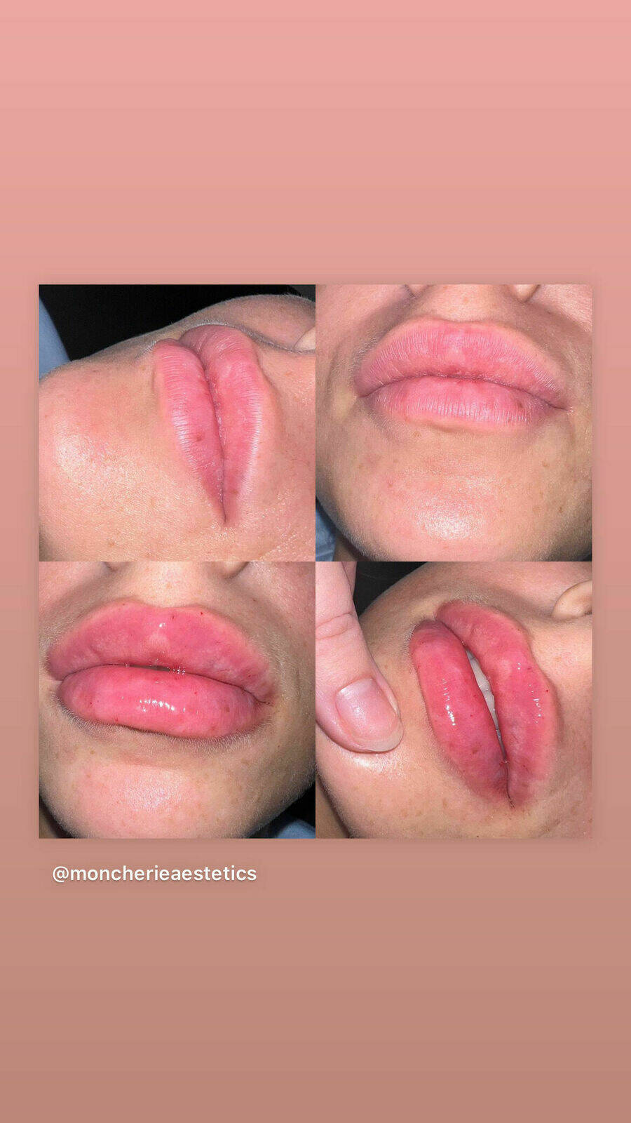 1.1 ml Lip Filler