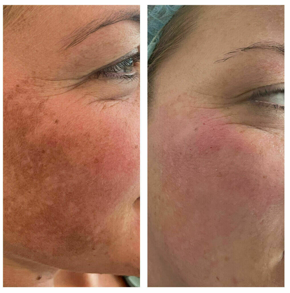 Décaar results -3 Treatments 