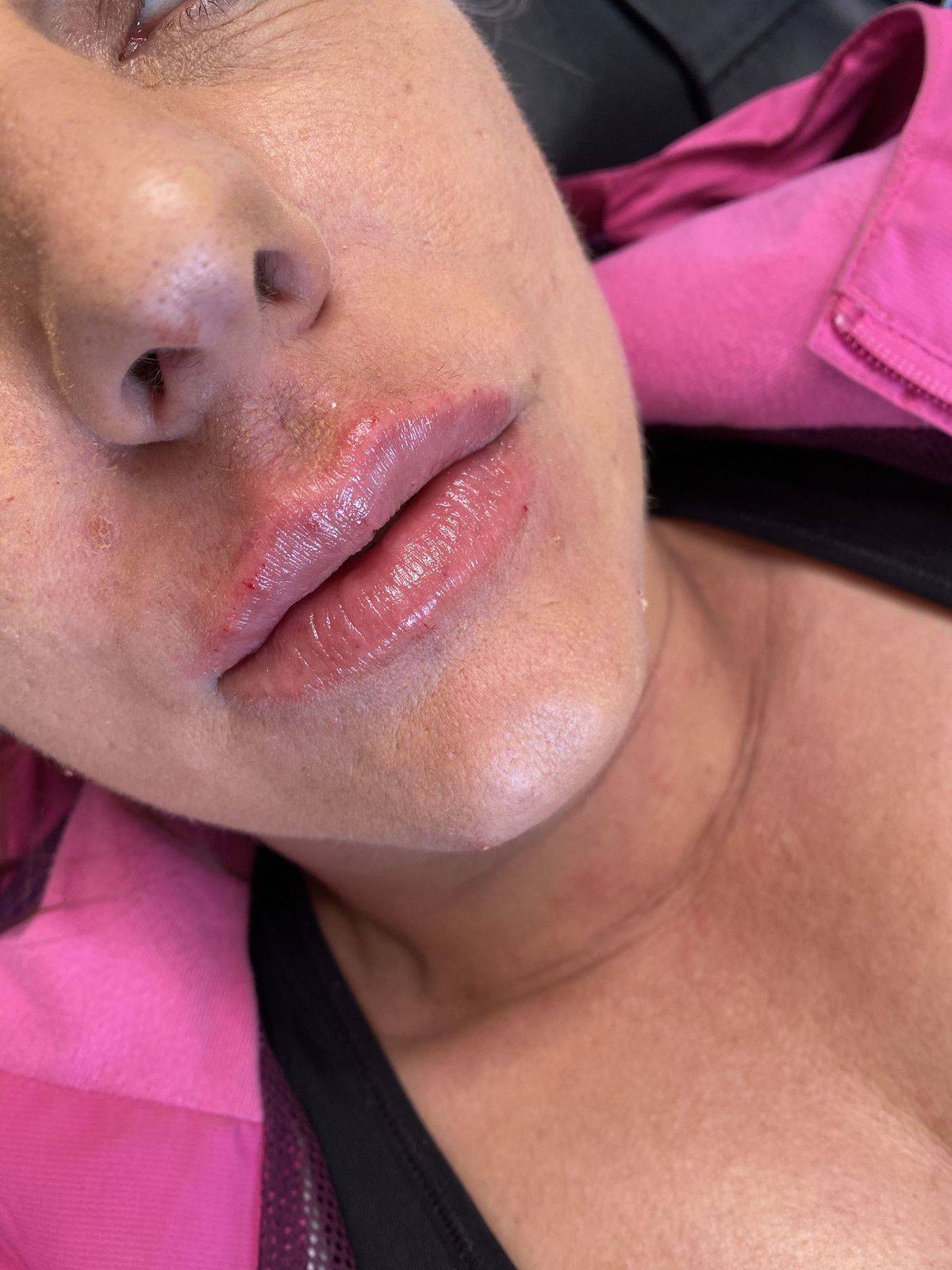 Lip Fillers Before and After
