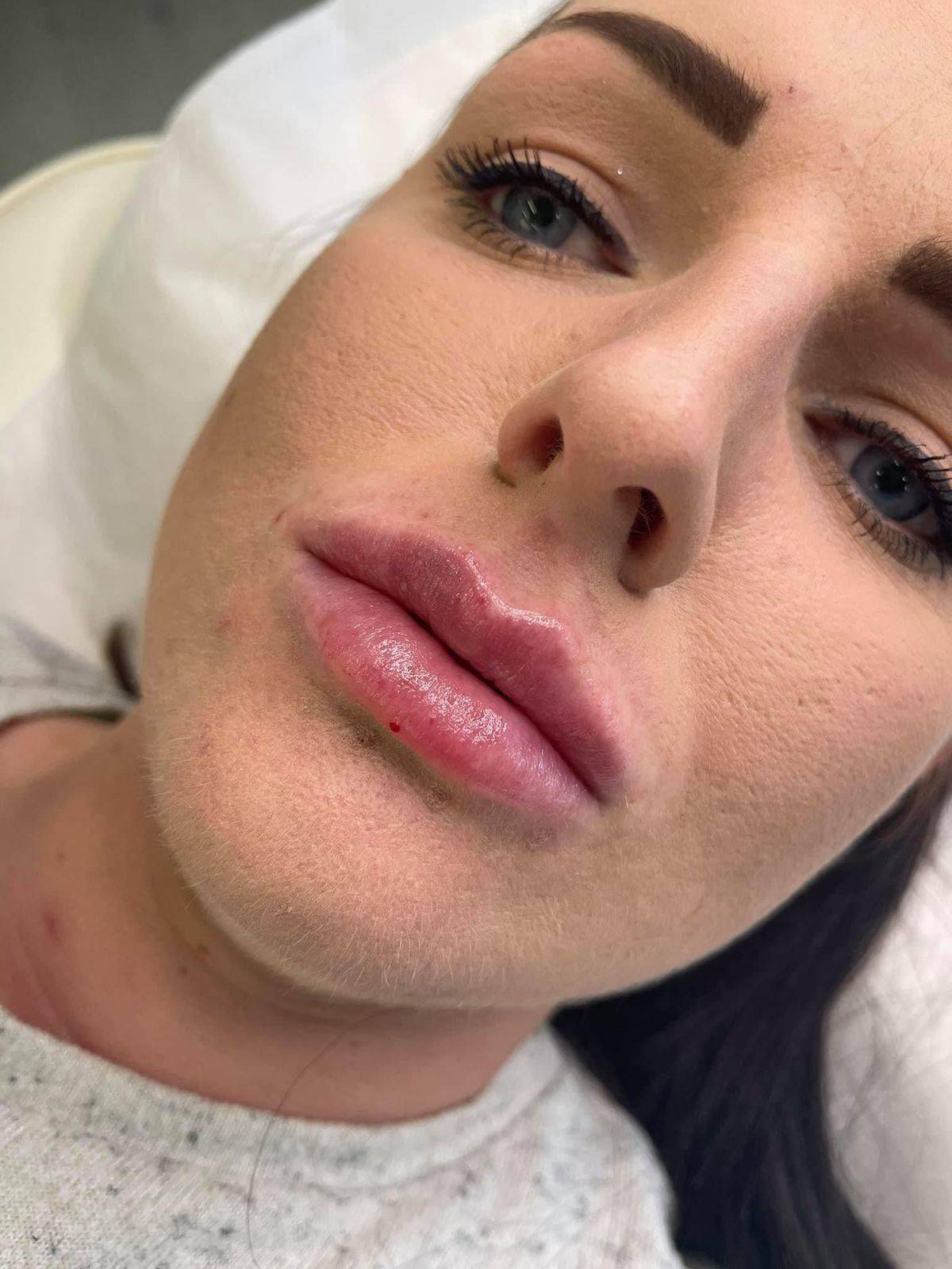 1.1ml Lip Enhancement 