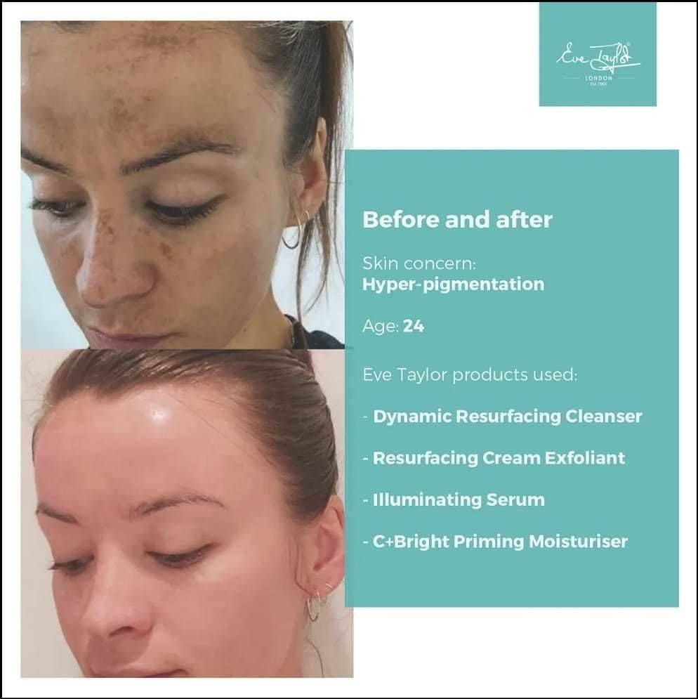 Before and After Pictures using Eve Taylor Skincare products. These work great alongside a SkinSpecific Facial available from The Beauty Box, Duston, Northampton. 