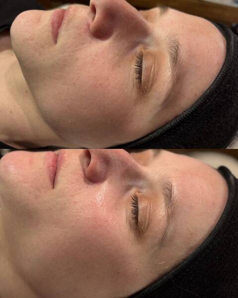 Résultat soin Hydrofacial 
