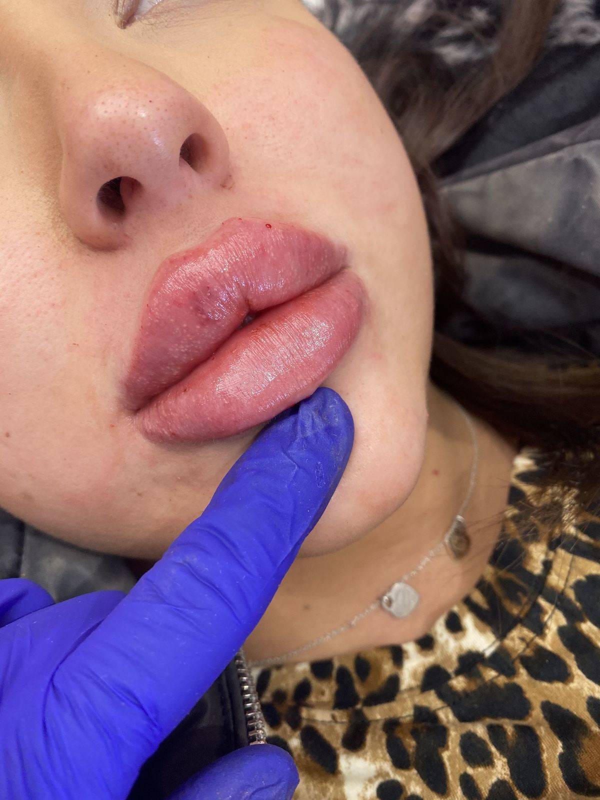 Rᴜssɪᴀɴ ᴏᴠᴇʀʟᴀʏ ᴏɴ ᴘʀᴇғɪʟʟᴇᴅ ʟɪᴘs