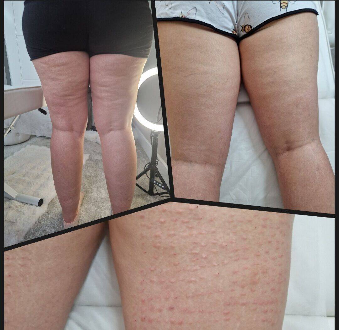 Derma Cellulite treatment