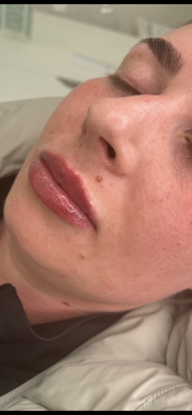 1.1ml Lip Enhancement 