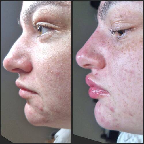 Non-surgical Rhinoplasty (nose) and Lip filler