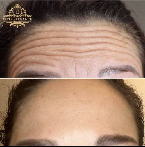 Antiwrinkle treatment 
