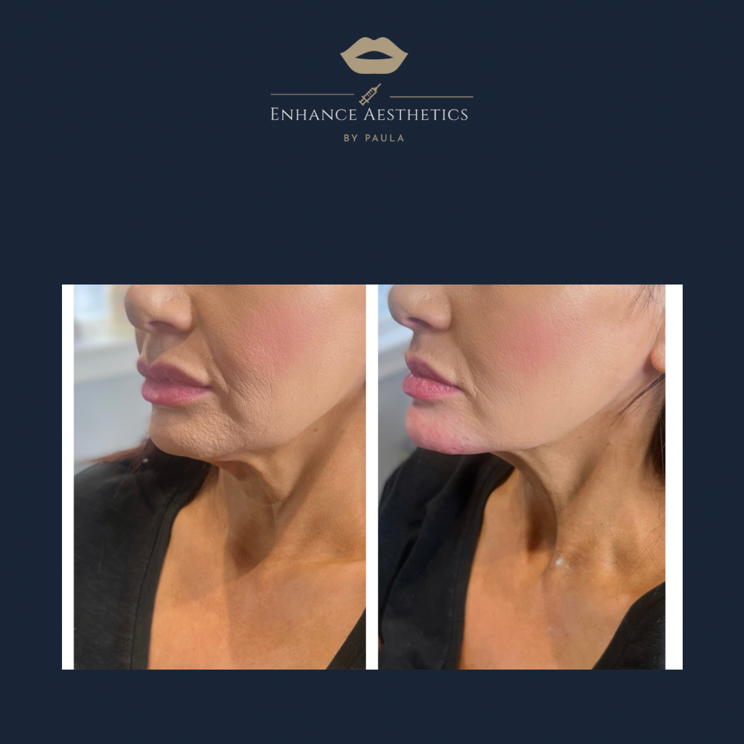 Chin Augmentation using Dermal Filler 1ml