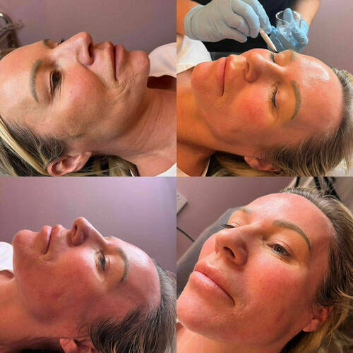 Chemical Peel