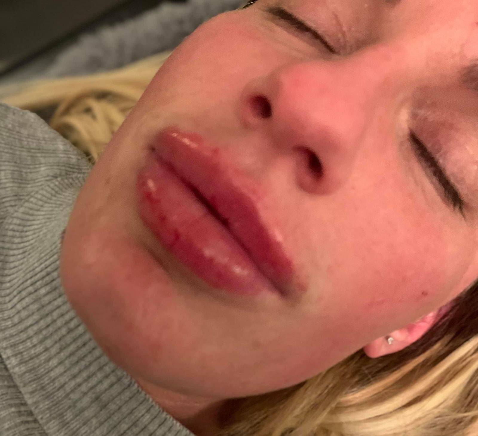 1.1ml Lip Enhancement 