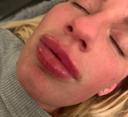 1.1ml Lip Enhancement 