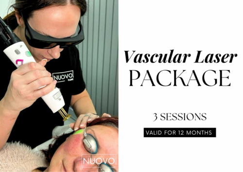 Face or Chest (Pigmentation, Veins or Redness) (3 Sessions)