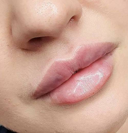 1.1ml Lip Enhancement 