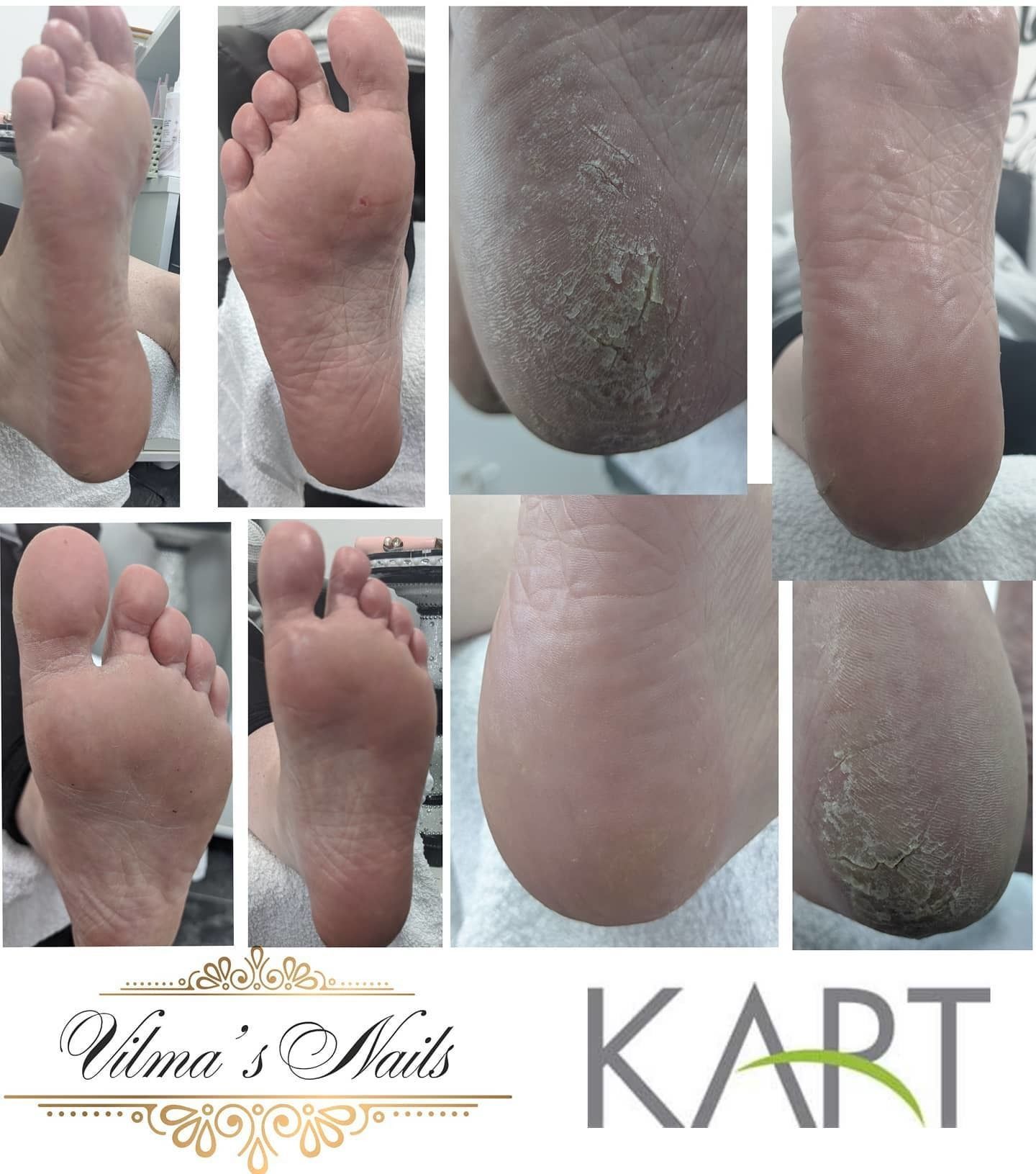 What amazing results.1st Kart Pedicure Treatment. Not Hesitate and make your appointment