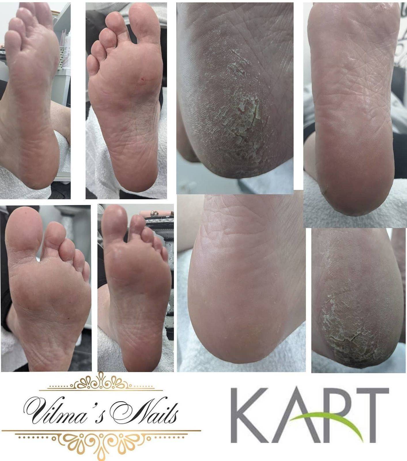 What amazing results.1st Kart Pedicure Treatment. Not Hesitate and make your appointment