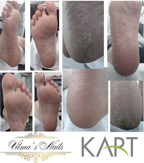 What amazing results.1st Kart Pedicure Treatment. Not Hesitate and make your appointment
