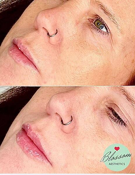 Lip filler
